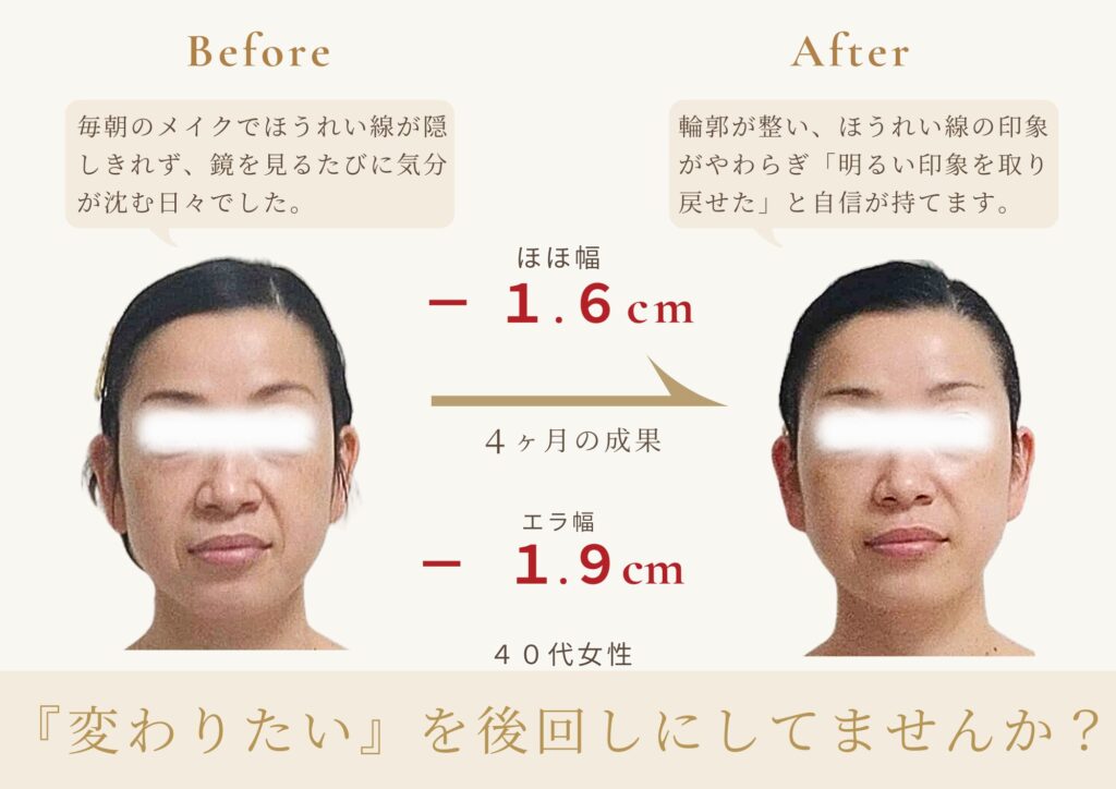 足立区梅島AloHaの小顔矯正|40代女性のほうれい線改善と自然な笑顔のビフォーアフター