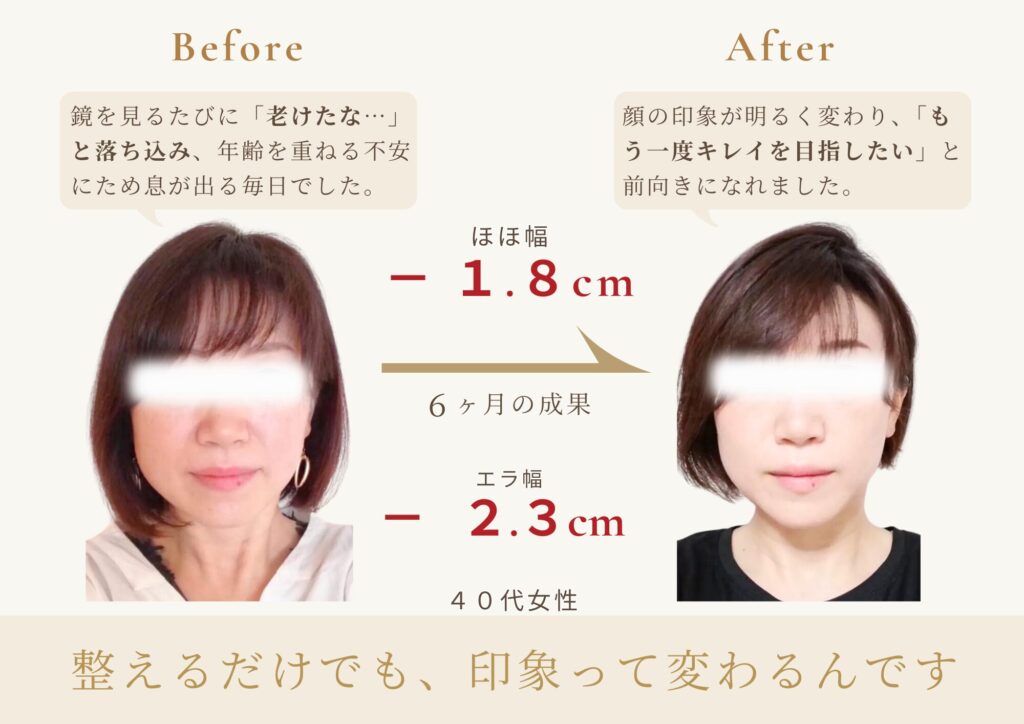 40代女性の小顔矯正ビフォーアフター。足立区梅島AloHaで6か月施術を受け、ほほ幅－1.8cm・エラ幅－2.3cm。老け見えが改善され、若々しい印象に変わった事例